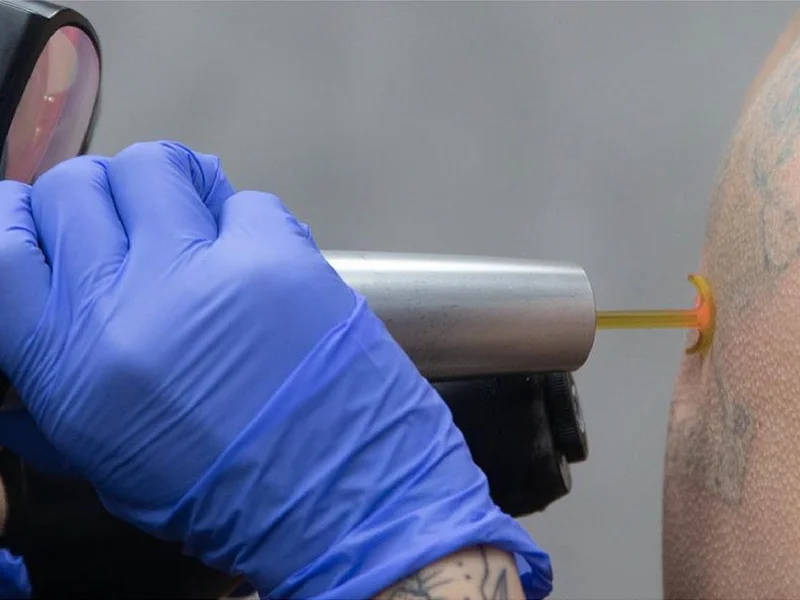 Removery Tattoo Removal & Fading