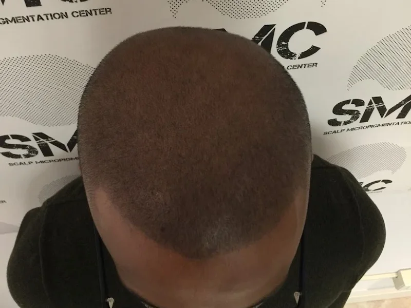 Scalp Micropigmentation Center