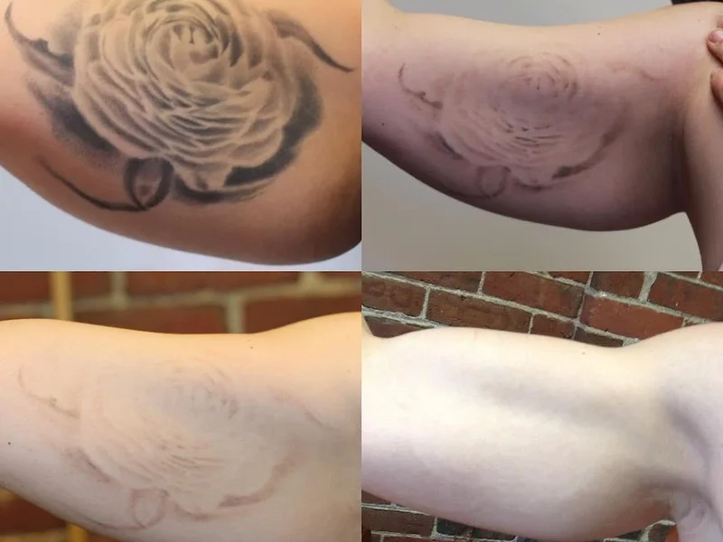 Removery Tattoo Removal & Fading