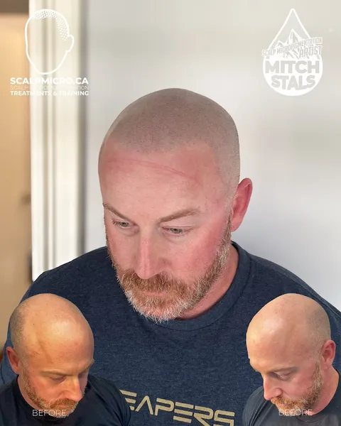 SCALPMICRO Scalp Micropigmentation Edmonton