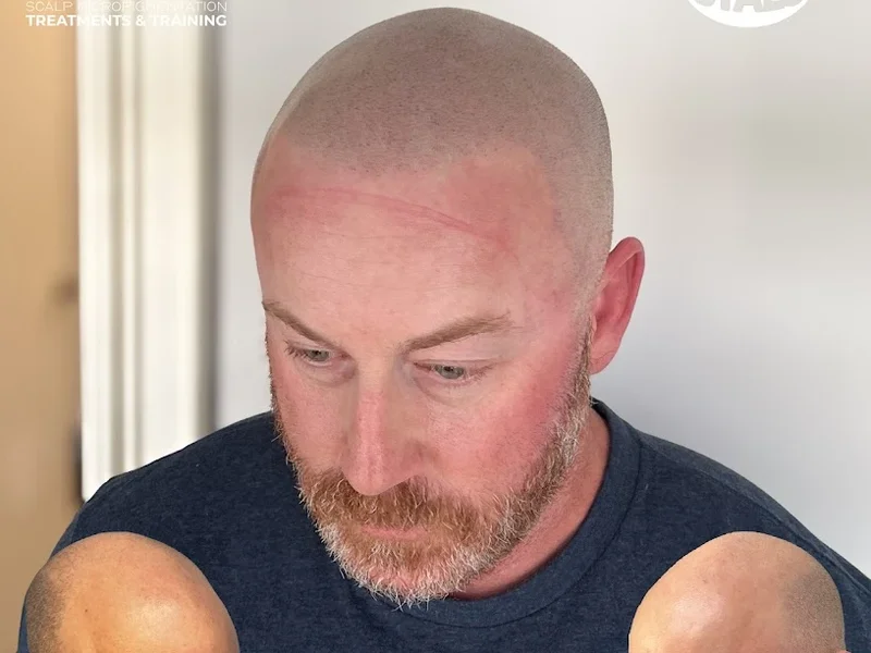 SCALPMICRO Scalp Micropigmentation Edmonton