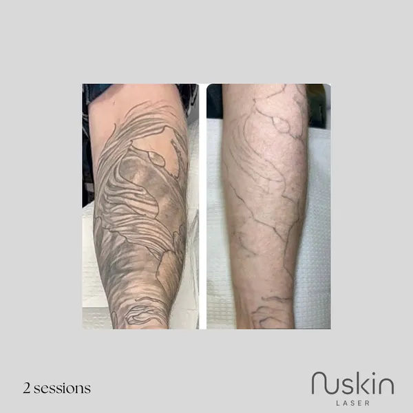 NuSkin Laser & Tattoo Removal