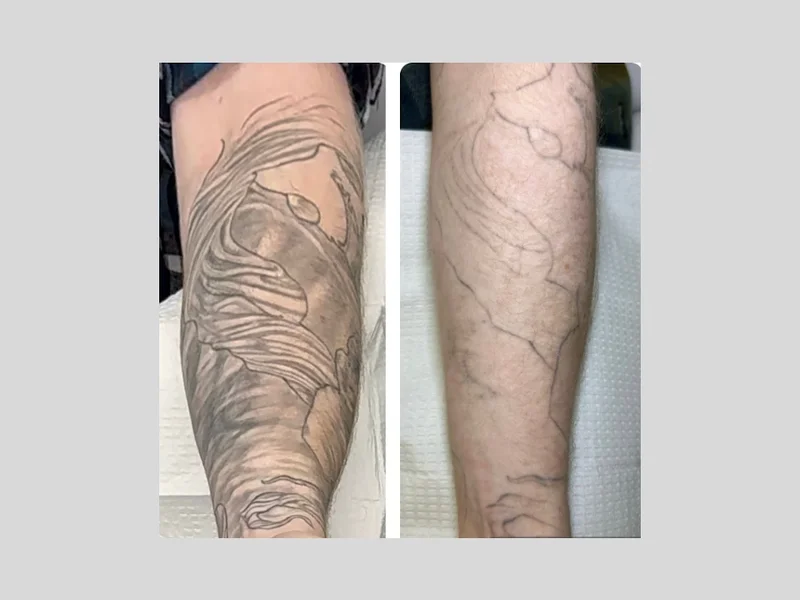 NuSkin Laser & Tattoo Removal