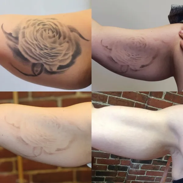 Removery Tattoo Removal & Fading