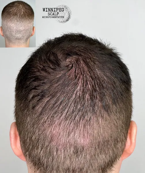 Winnipeg Scalp Micropigmentation