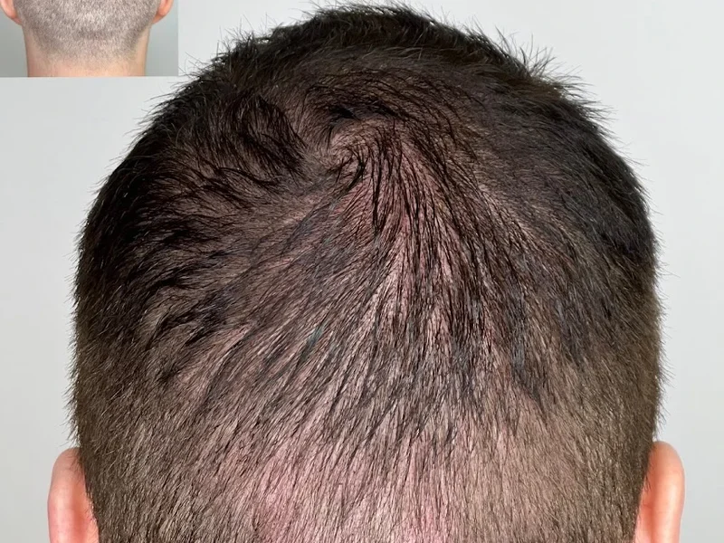 Winnipeg Scalp Micropigmentation