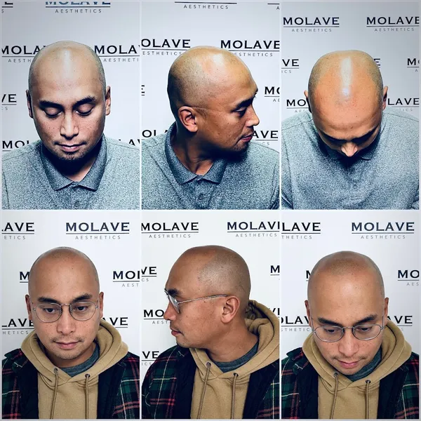 Molave Scalp Micropigmentation