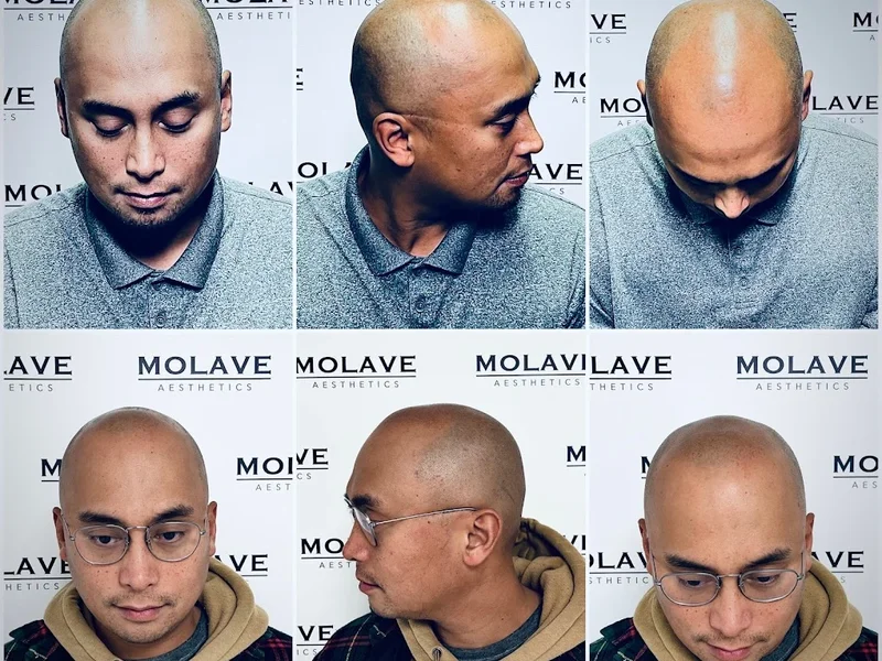 Molave Scalp Micropigmentation