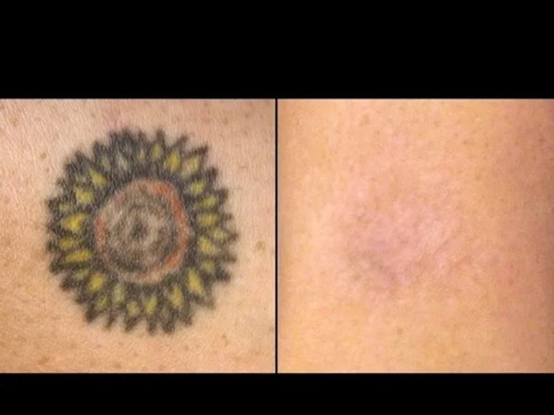 Ink Re-Think Removal Clinic