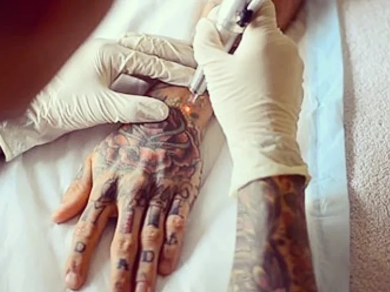 Tattoo Time Machine Laser Clinic