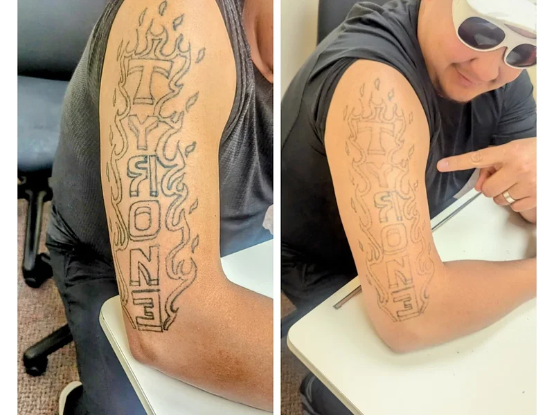 Bionic Tattoo Removal