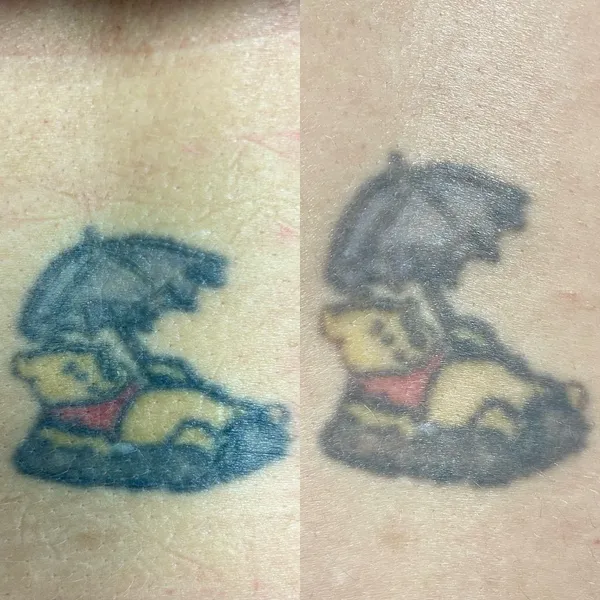 Fadeaway Winnipeg Tattoo Removal