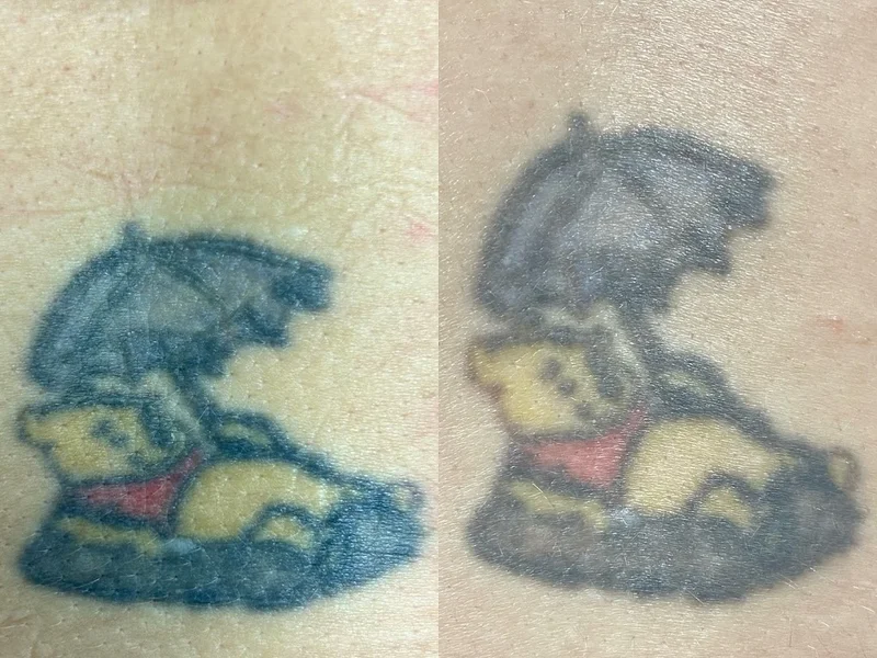 Fadeaway Winnipeg Tattoo Removal
