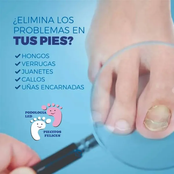 Podologia Laser Piecitos Felices y Podologia Laser Pies Sanos