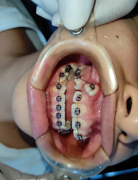 Brackets, Ortodoncia, Blanqueamiento, Diseño de Sonrisa en lima - ODONTO AESTHETIC