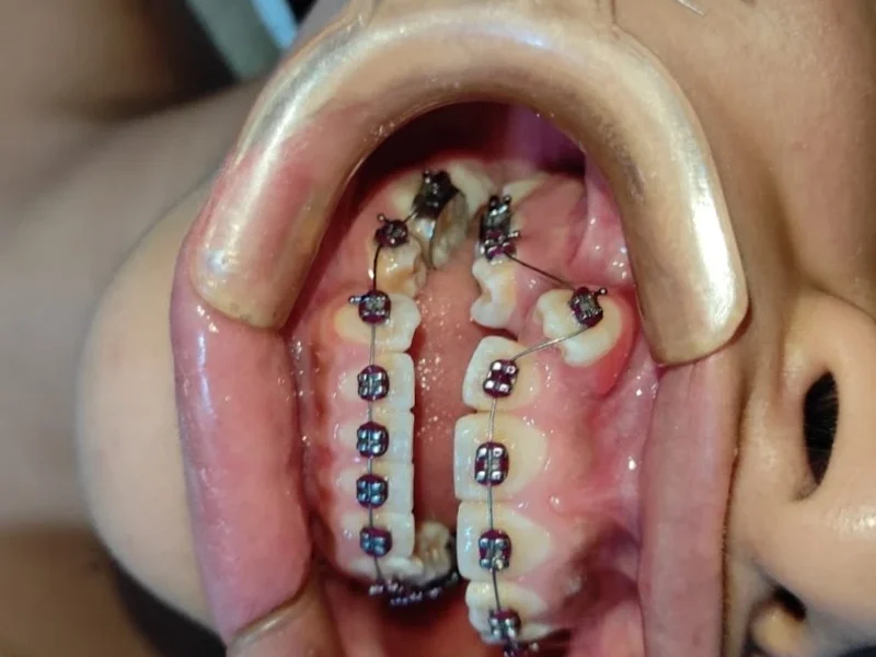 Brackets, Ortodoncia, Blanqueamiento, Diseño de Sonrisa en lima - ODONTO AESTHETIC