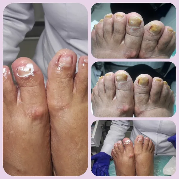 PODIATRY SUAREZ PODOLOGIA INTEGRAL LASER OZONO tratamientos surco monterrico lima edwards