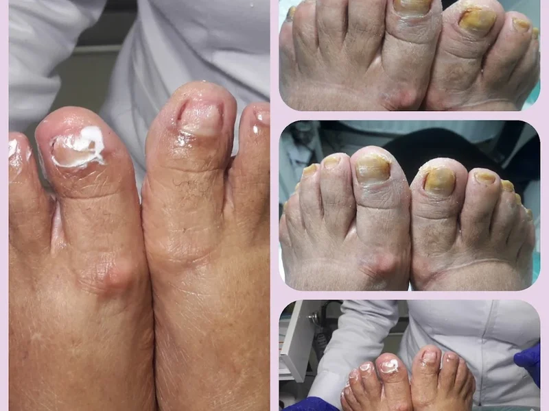 PODIATRY SUAREZ PODOLOGIA INTEGRAL LASER OZONO tratamientos surco monterrico lima edwards