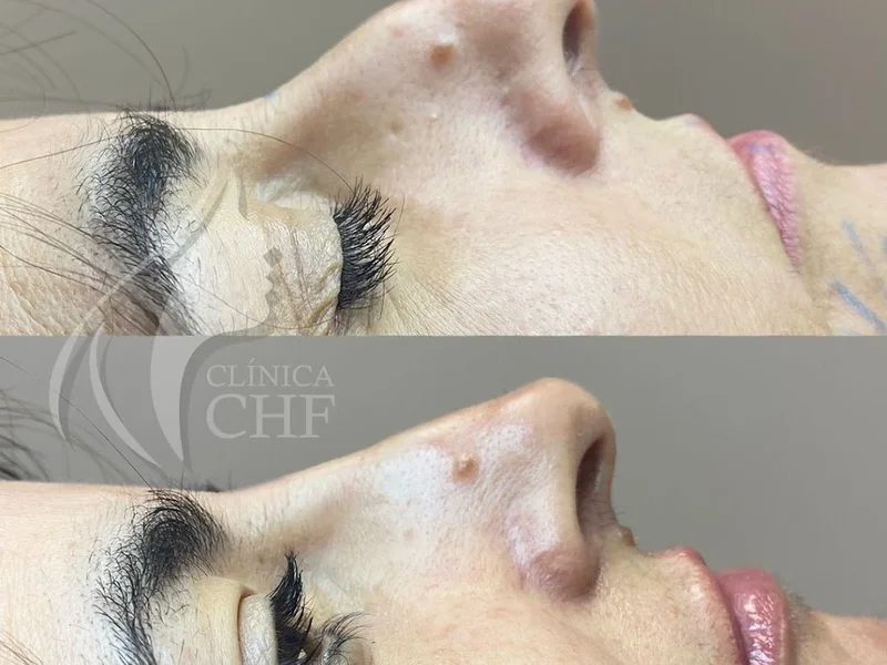 Clínica CHF Viseu - Harmonização e Rejuvenescimento Facial