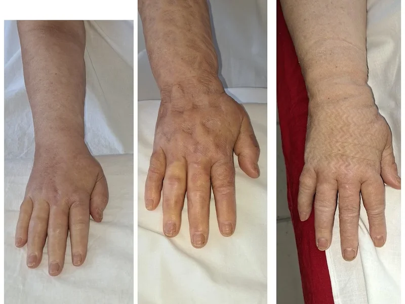 Drenaj limfatic manual