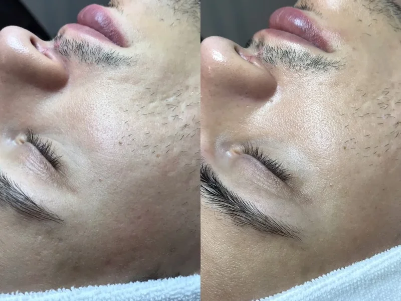 Beautyculture By Janine - Fillers, Profhilo & Hudvård Uppsala