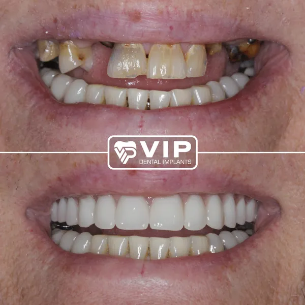 VIP Dental Implants Montrose