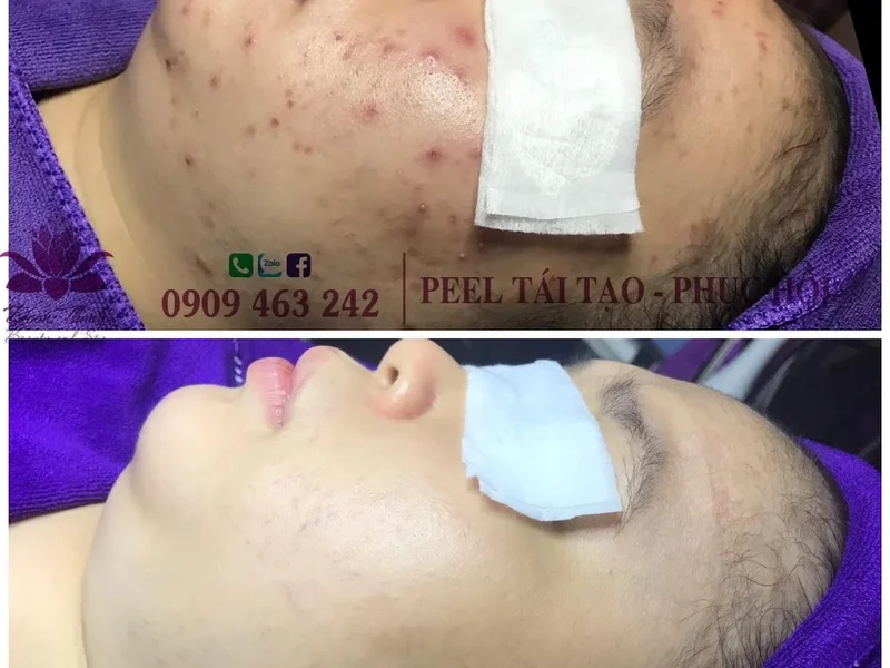 TRỊ MỤN QUẬN 8 | SPA ĐOAN THANH | TRỊ NÁM QUẬN 8 | SPA QUẬN 8